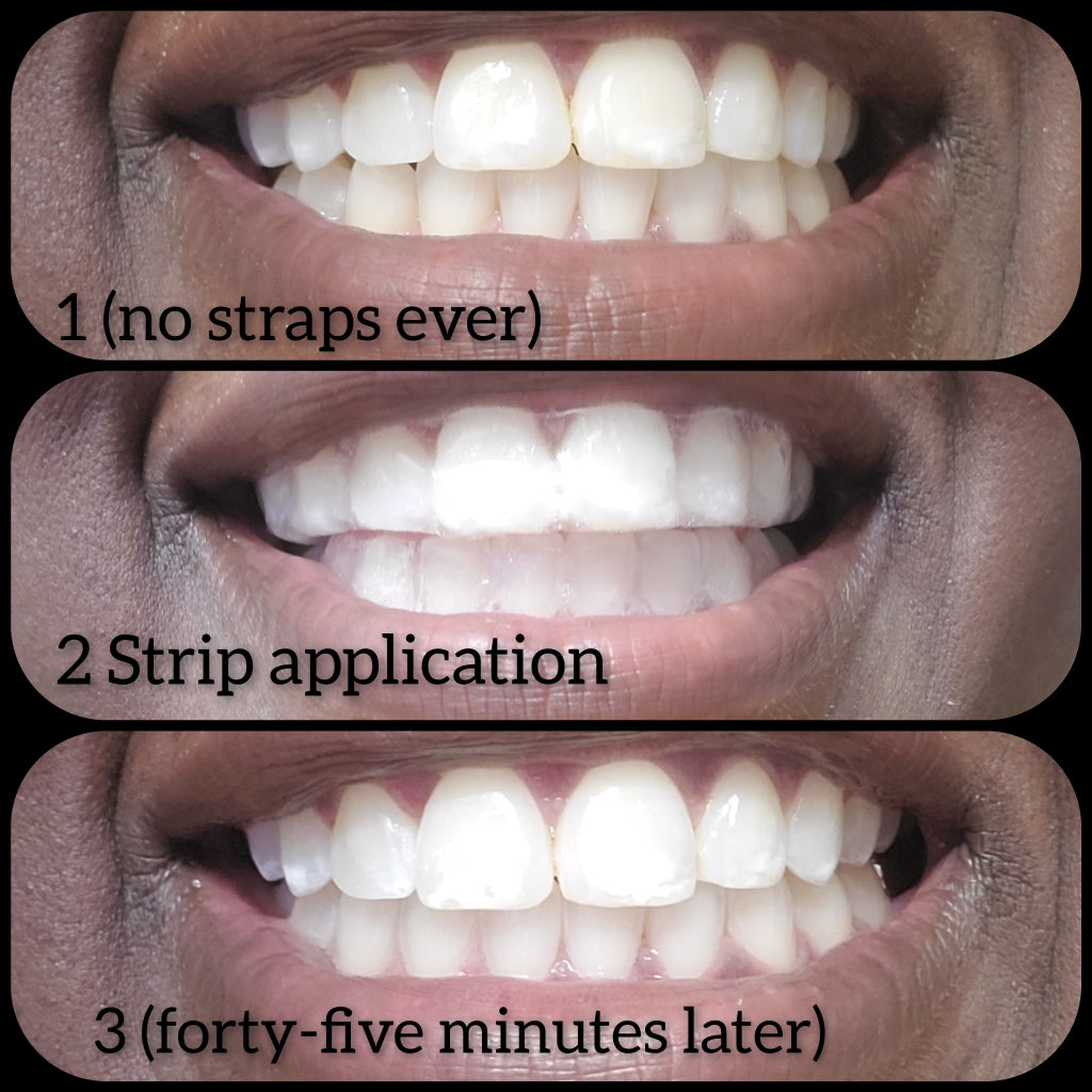 Teeth Whitening Strips